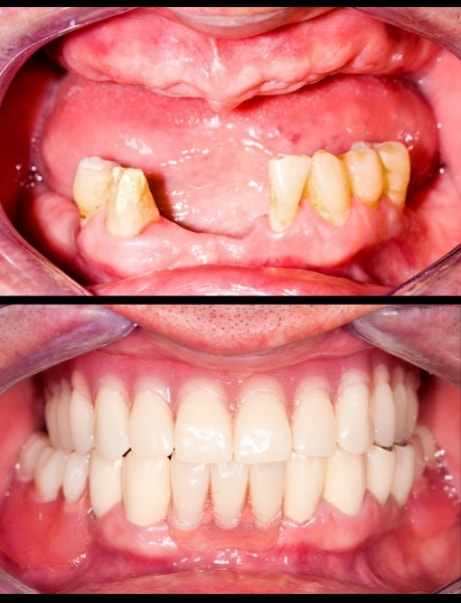 Prothèse dentaire - Cas 2